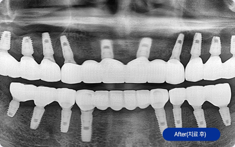 임플란트 치료 후 X-ray