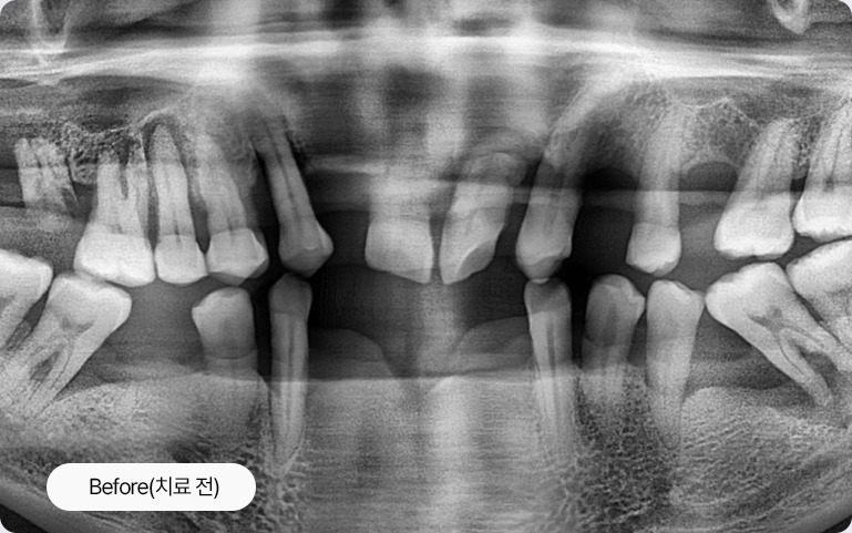 임플란트 치료 전 X-ray